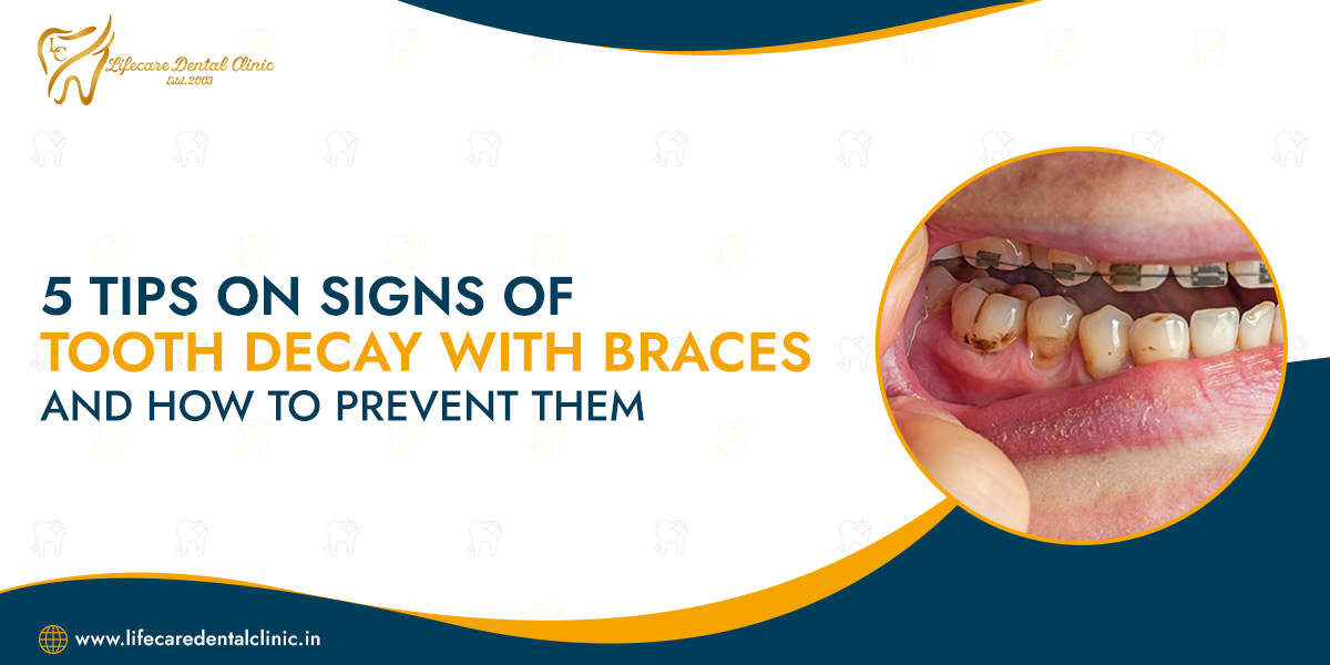 5-Tips-on-Signs-of-Tooth-Decay-with-Braces-and-How-to-Prevent-them