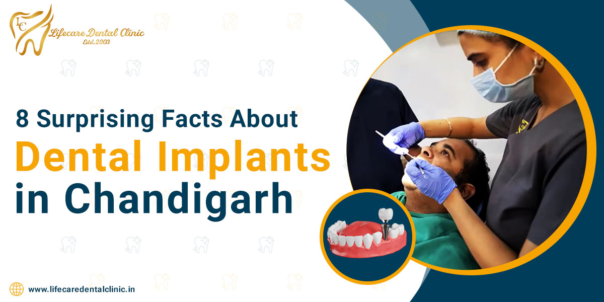 8-surprising-facts-about-dental-implants-in-chandigarh