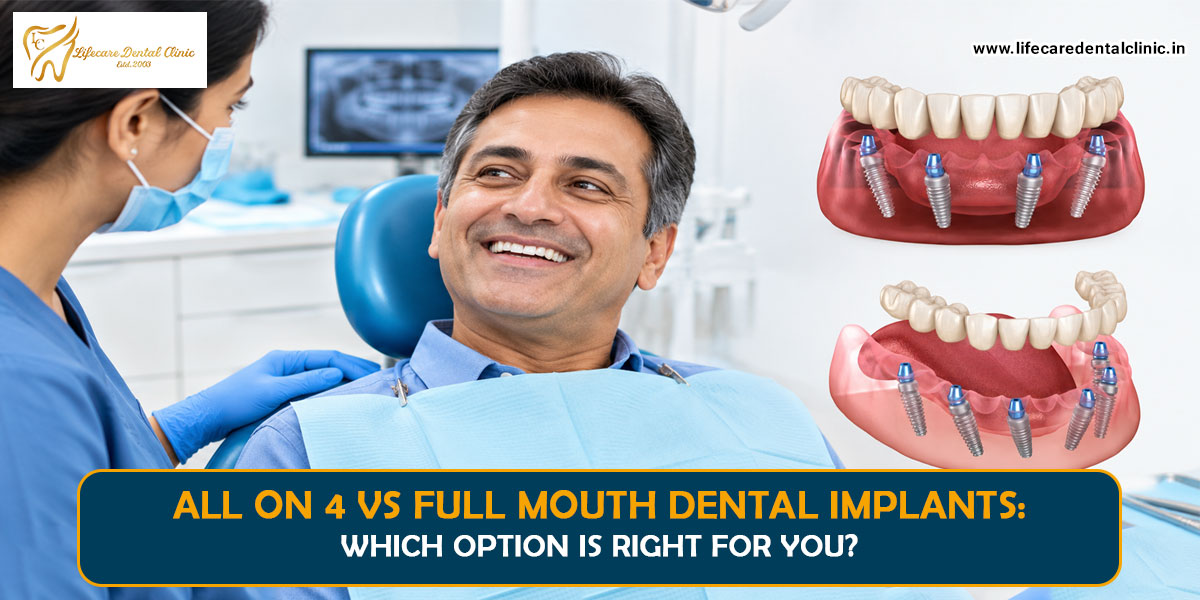 All-on-4-vs-Full-Mouth-Dental-Implants