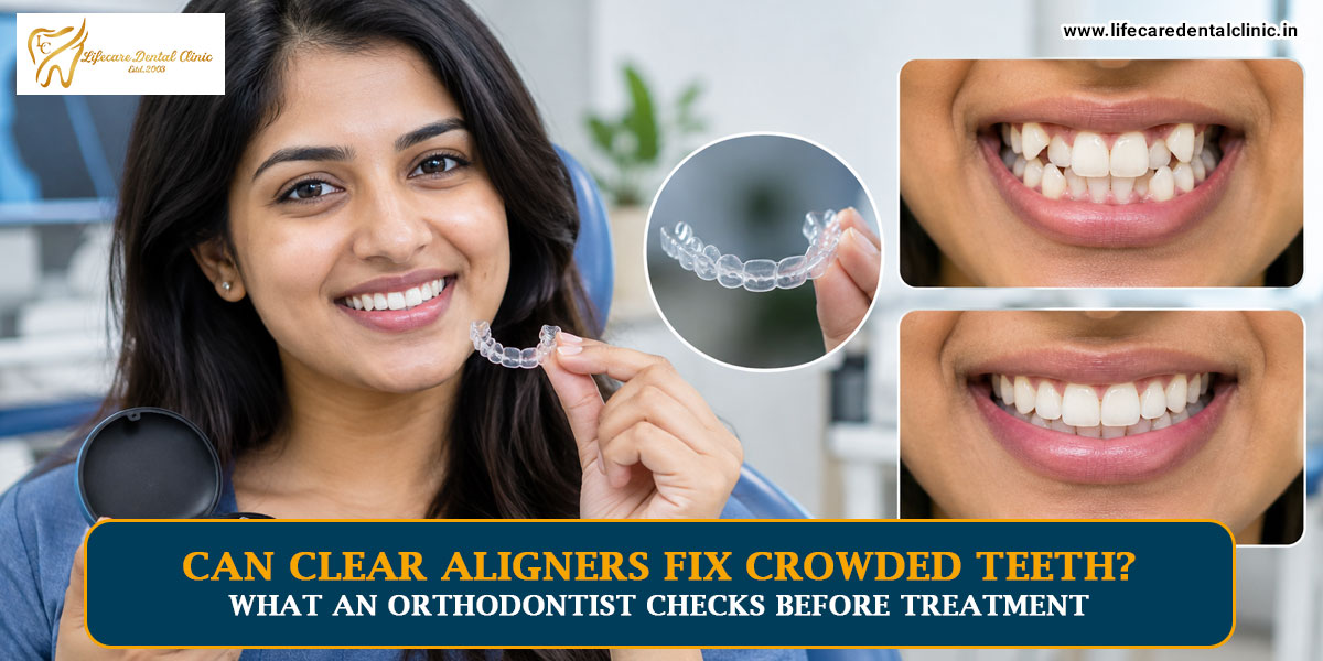 Can-Clear-Aligners-Fix-Crowded-Teeth