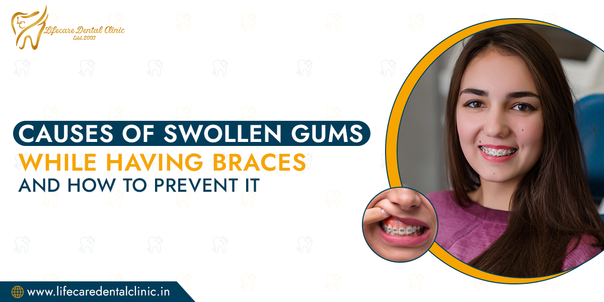 Causes-of-Swollen-Gums-While-Having-Braces-and-How-to-Prevent-it(1)