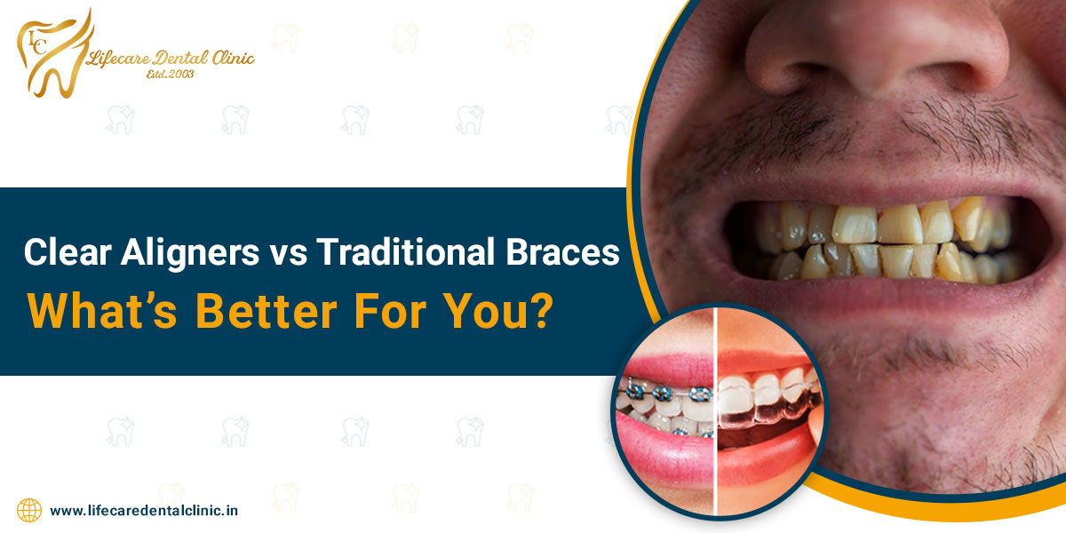Clear Aligners vs Traditional Braces – What’s Better For You?