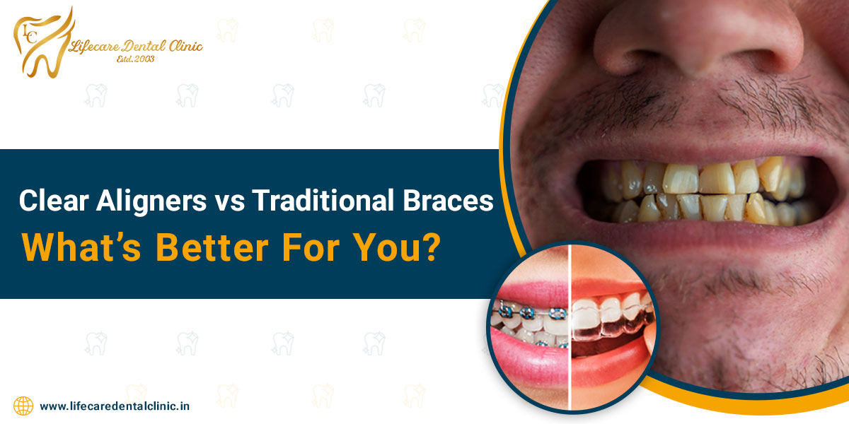 Clear-Aligners-vs-Traditional-Braces-–-What’s-Better-For-You