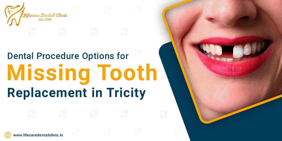 Dental-Procedure-Options-for-Missing-Tooth-Replacement-in-Tricity