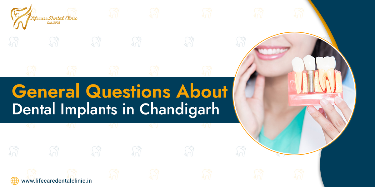 General-Questions-About-Dental-Implants-in-Chandigarh