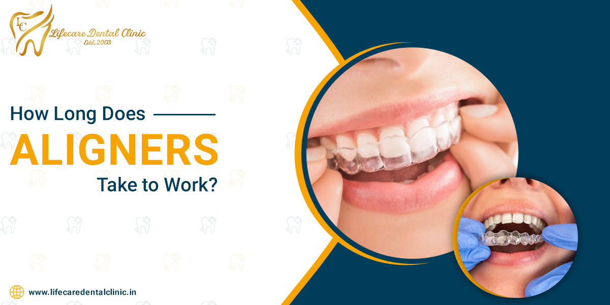 How-Long-Does-Aligners-Take-to-Work