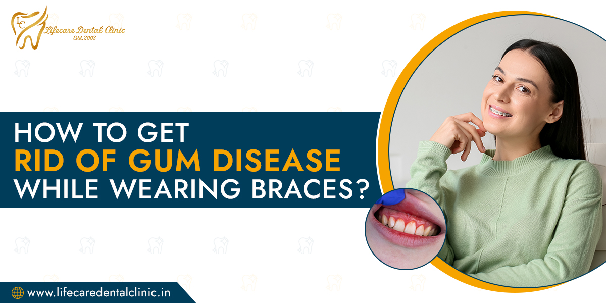 How-to-Get-Rid-of-Gum-Disease-While-Wearing-Braces