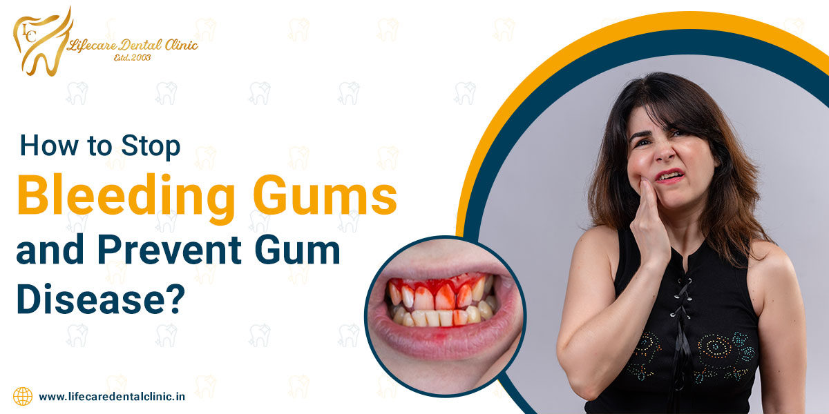 How-to-Stop-Bleeding-Gums-and-Prevent-Gum-Disease