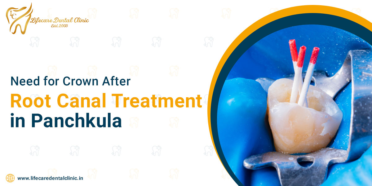 Need-for-Crown-After-Root-Canal-Treatment-in-Panchkula