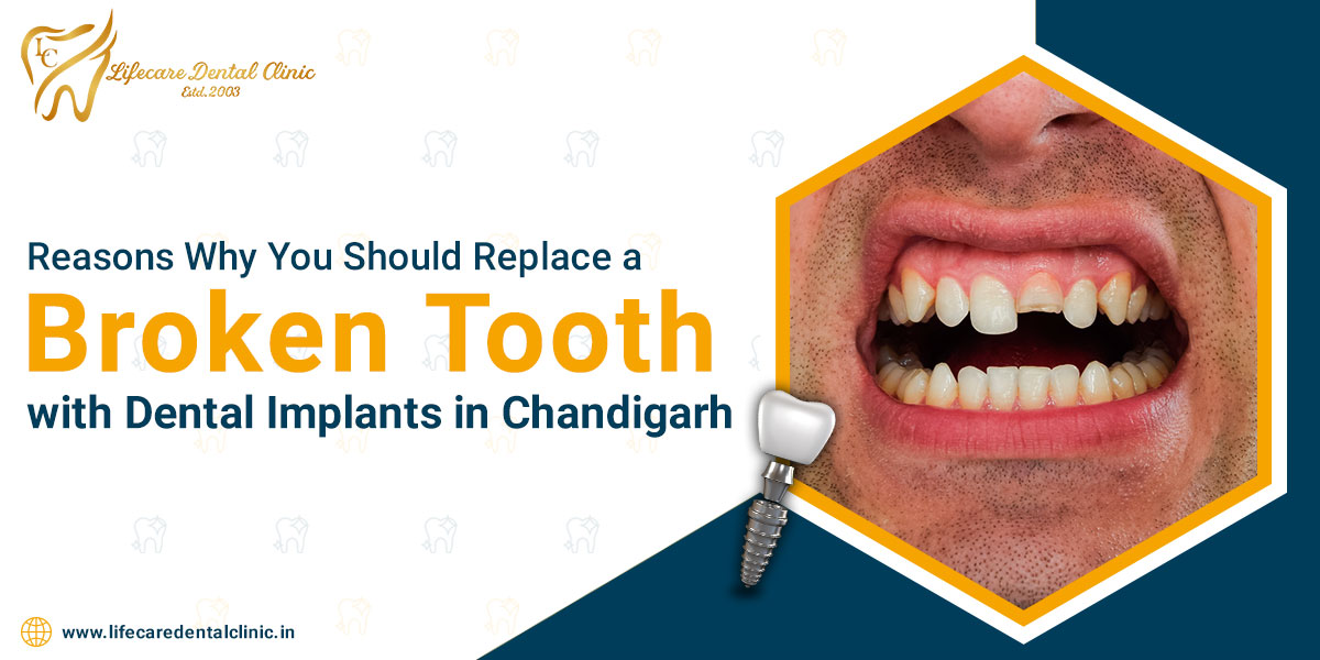 Reasons-Why-You-Should-Replace-a-Broken-Tooth-with-Dental-Implants-in-Chandigarh