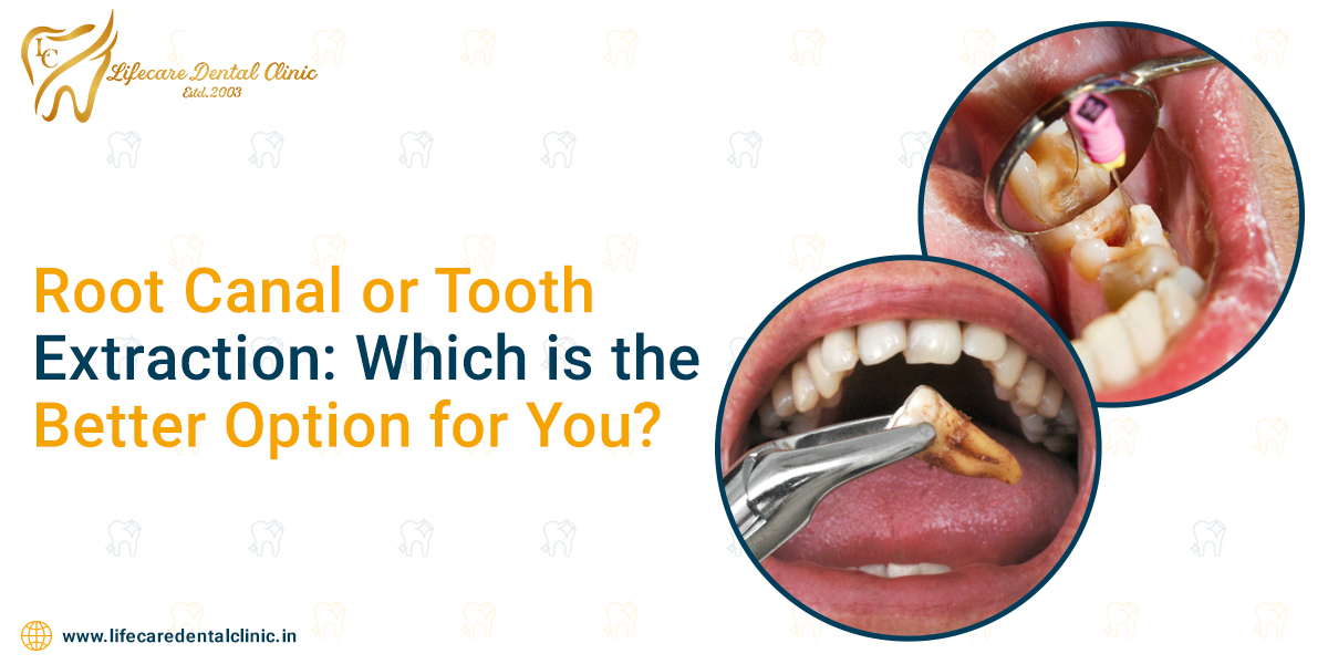 Root-Canal-or-Tooth-Extraction-Which-is-the-Better-Option-for-You