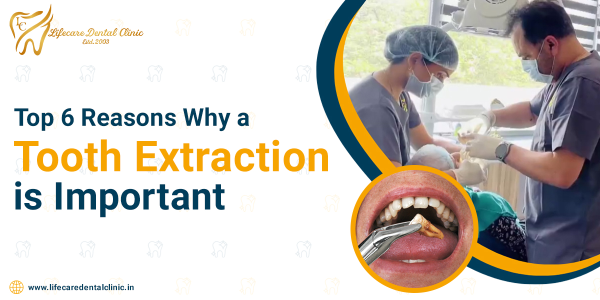 Top-6-Reasons-Why-a-Tooth-Extraction-is-Important