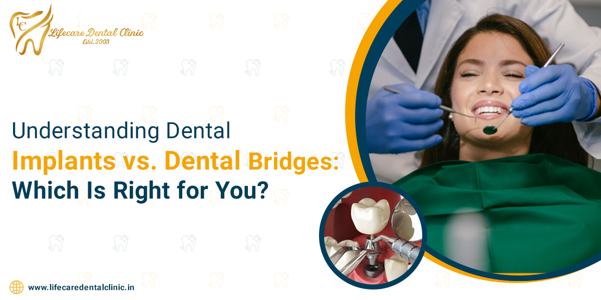 Understanding-Dental-Implants1