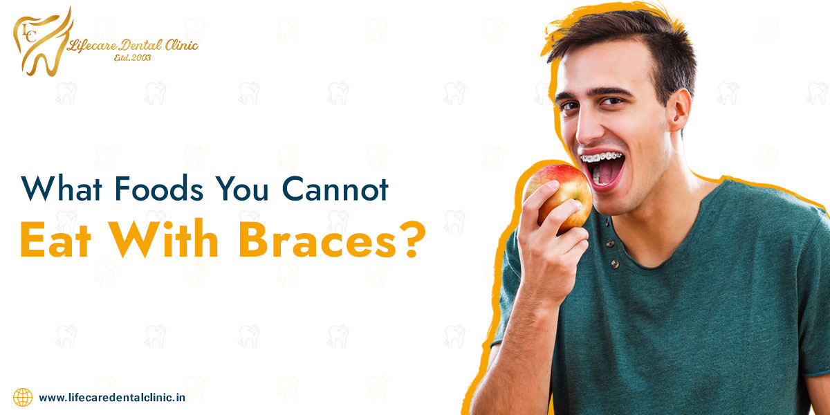 What-Foods-You-Cannot-Eat-With-Braces(1)