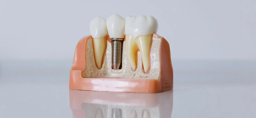 dental Implants in chandigarh