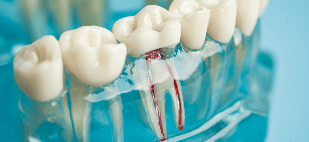 Dental Veneer in Chandigarh